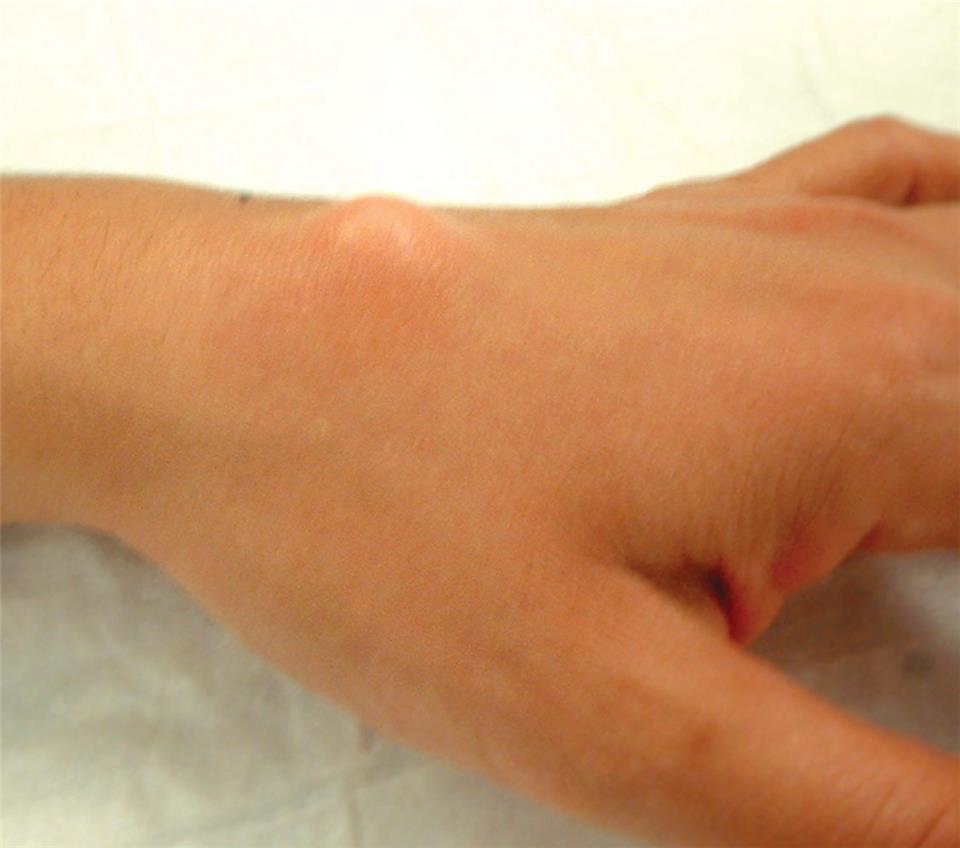Figure 1: A ganglion cyst on the top side (dorsum) of the wrist