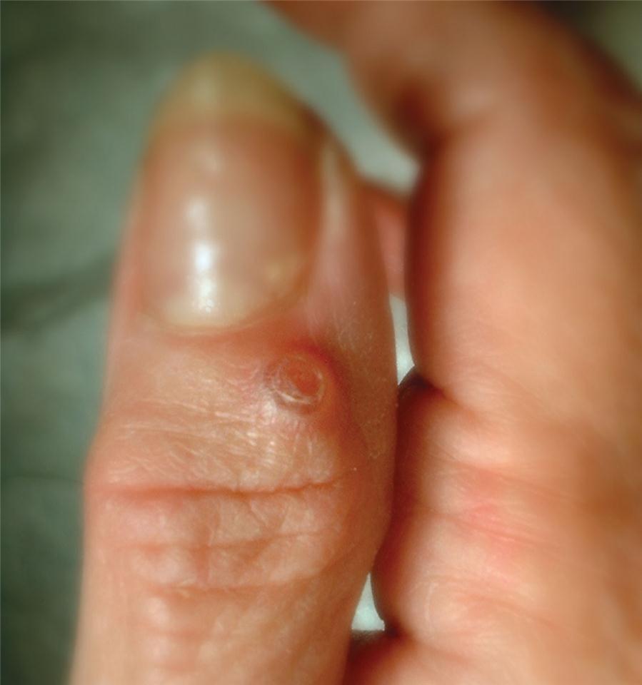 Figure 2: A ganglion cyst at the end joint of the finger (mucous cyst).