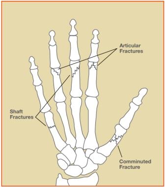 Figure 1: Examples of fractures in fingers.