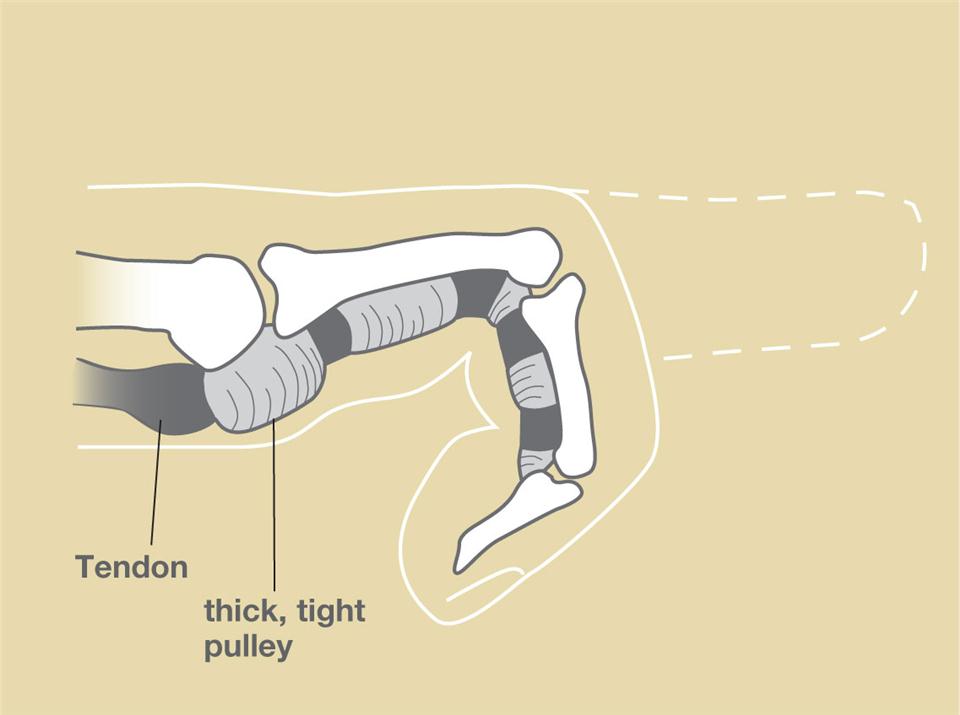 Figure 2:  If the pulley becomes too thick, the tendon cannot glide through it.